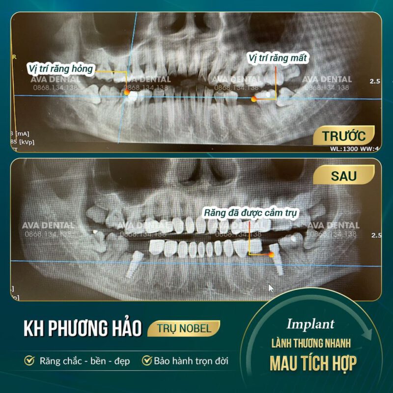 cắm implant có đau không