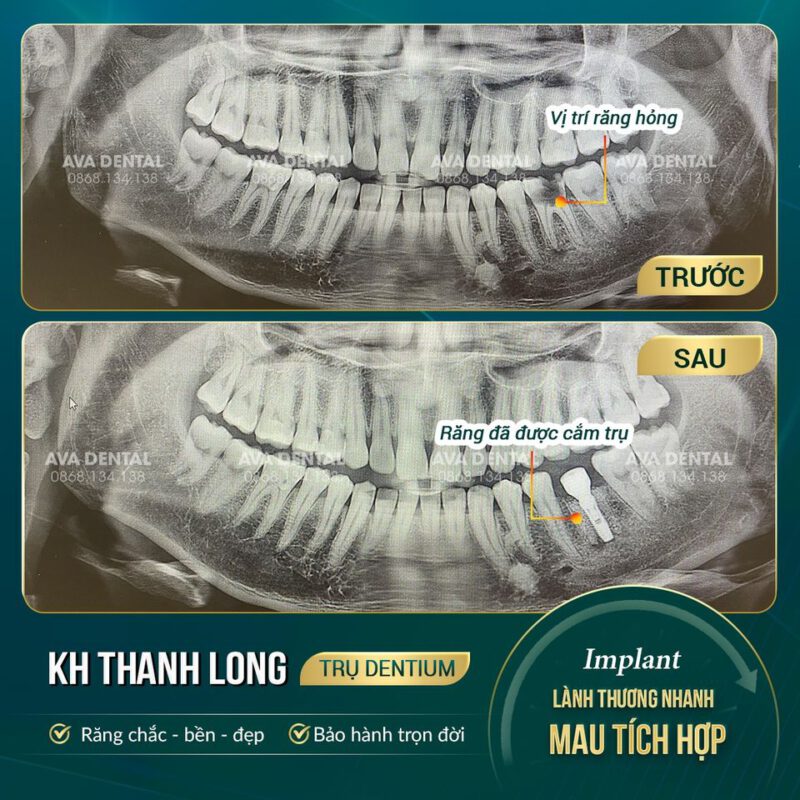 cắm implant có đau không