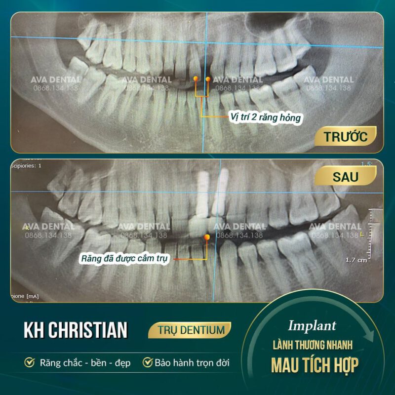 cắm implant có đau không