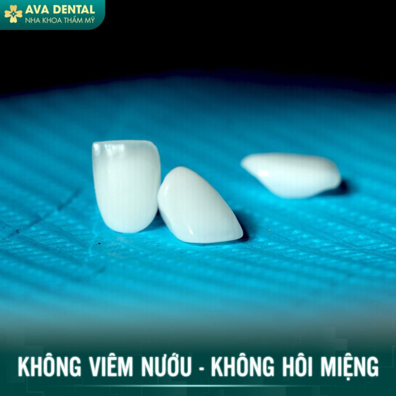 dán sứ veneer
