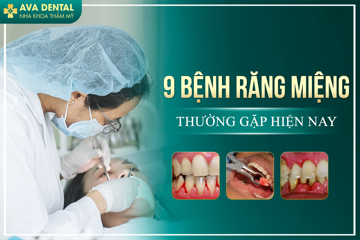 9 BỆNH VỀ RĂNG MIỆNG THƯỜNG GẶP HIỆN NAY 9 bệnh về răng