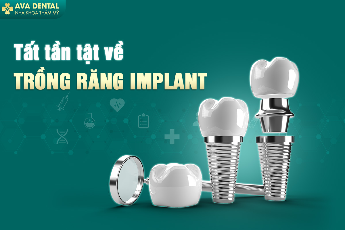 Tất Tần Tật Về Trồng Răng Implant Dành Cho Bạn 9 trồng răng implant