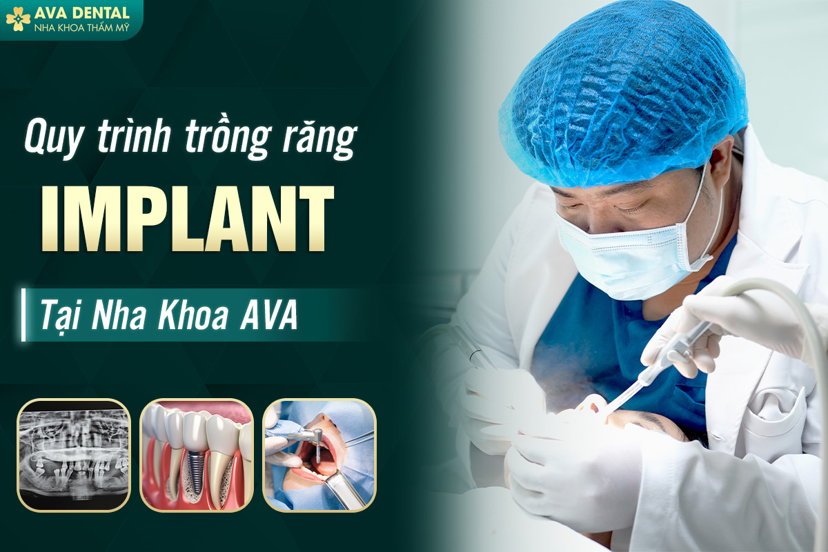 Quy Trình Trồng Răng Implant Tại Avora Dental 7 AVA 5