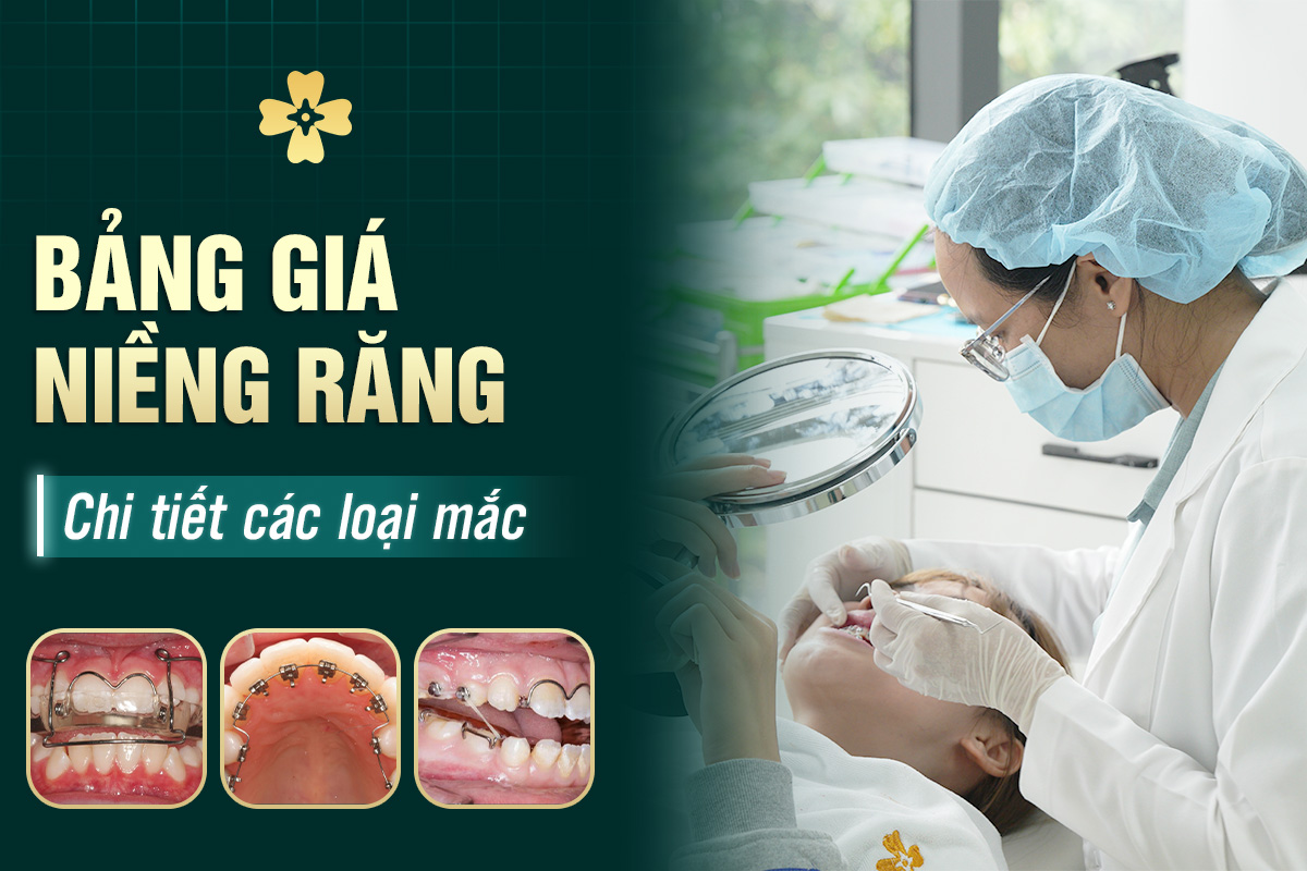 Tham Khảo Giá Niềng Răng Mắc Cài Kim Loại 14 giá niềng răng