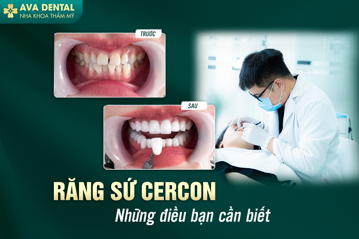 Răng Sứ Cercon - Những Điều Bạn Chưa Biết Cùng Avora Dental 7 răng sứ Cercon