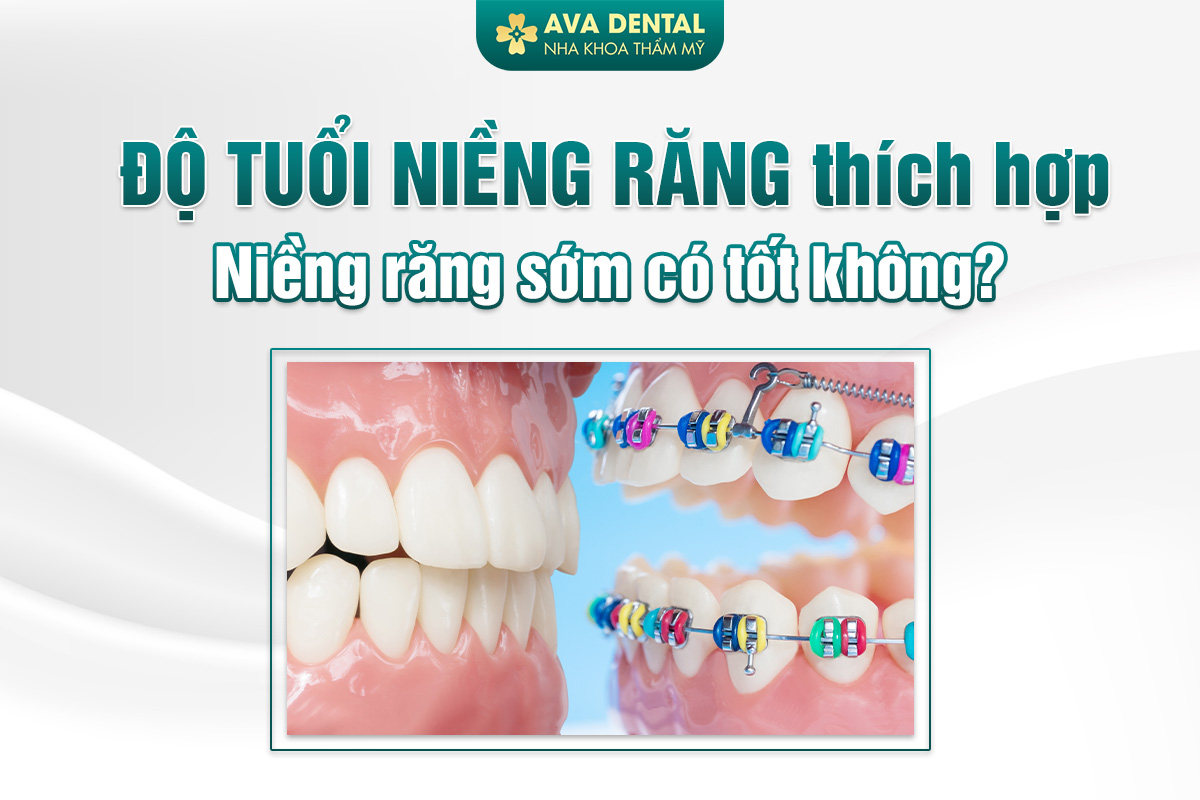 độ tuổi niềng răng