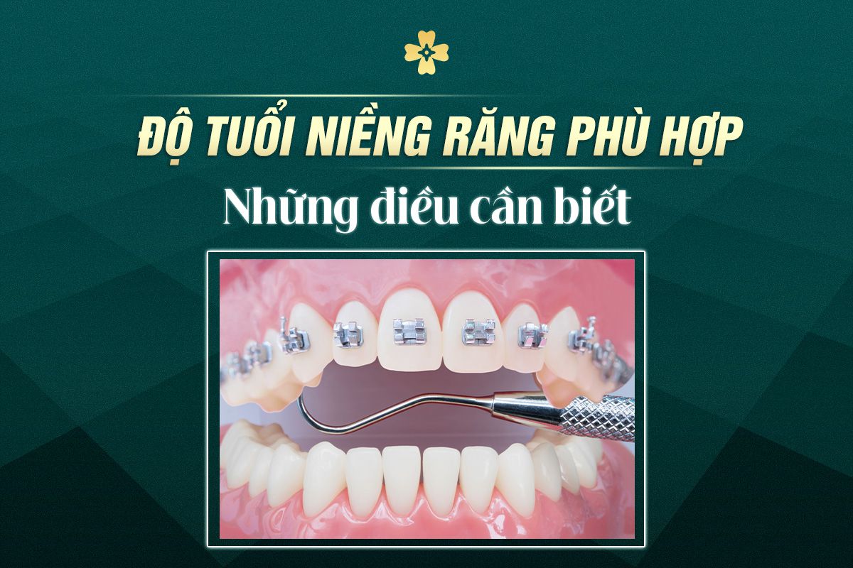 Độ Tuổi Niềng Răng Phù Hợp - Những Điều Cần Biết 8 độ tuổi niềng răng
