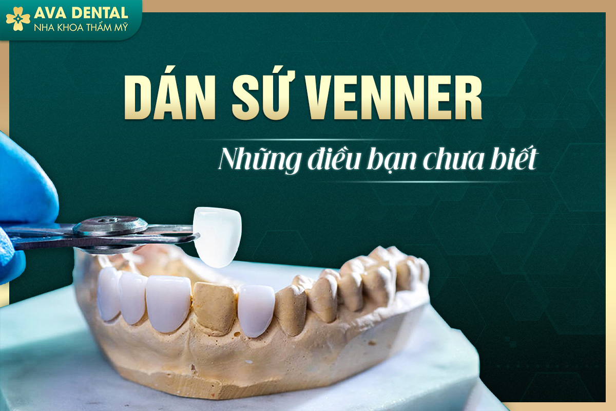 Dán Sứ Veneer Là Gì? Những Điều Có Thể Bạn Chưa Biết 7 dán sứ veneer