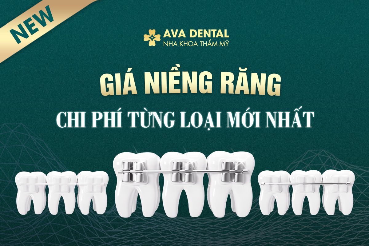 giá niềng răng