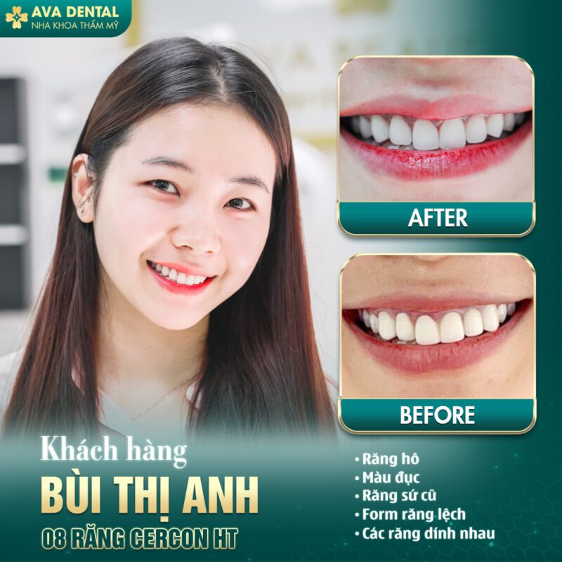 các loại răng sứ