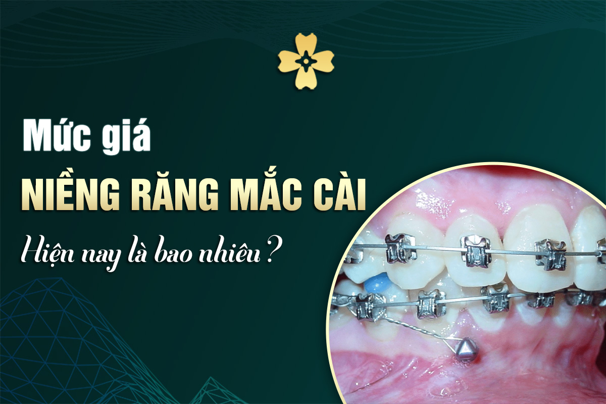Mức Giá Niềng Răng Mắc Cài Hiện Nay Là Bao Nhiêu? 7 giá niềng răng