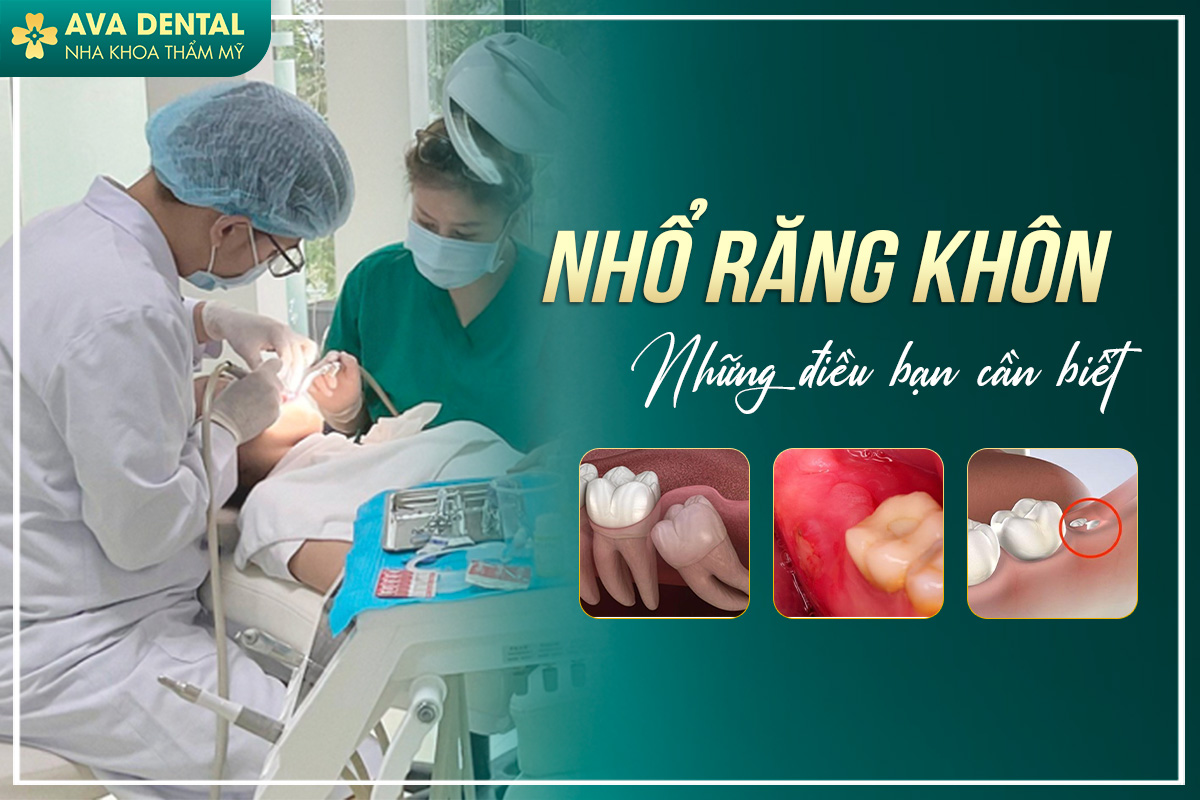 Những Điều Bạn Cần Biết Về Nhổ Răng Khôn - Avora Dental 9 nhổ răng khôn
