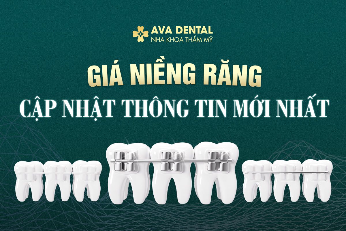 giá niềng răng