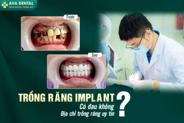 RANG IMPLANT