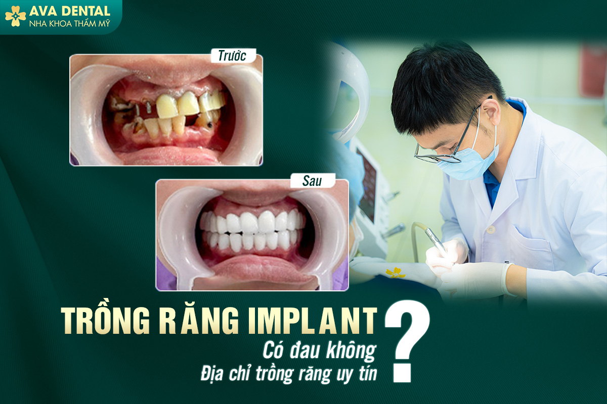 Trồng Răng Implant Có Đau Không? Địa Chỉ Trồng Răng Uy Tín 8 trồng răng implant