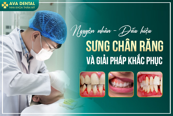 sưng chân răng