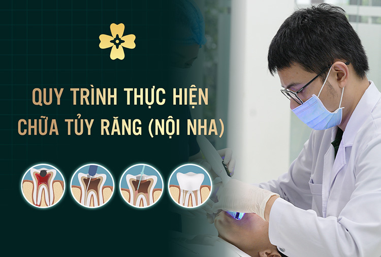 chữa tủy răng