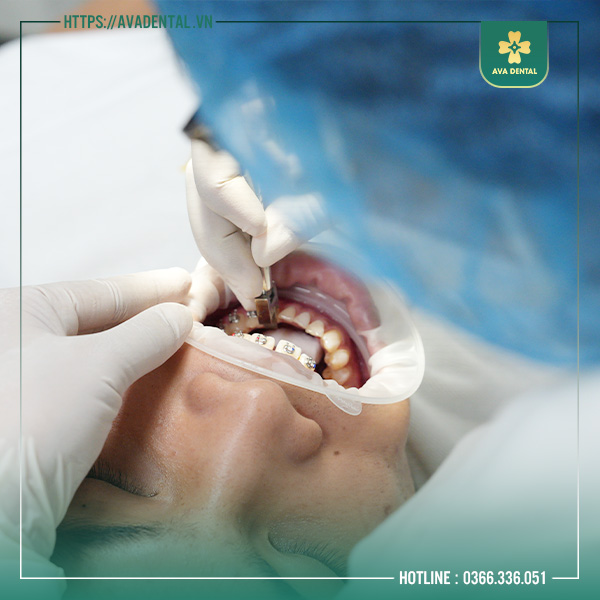 niềng răng trả góp