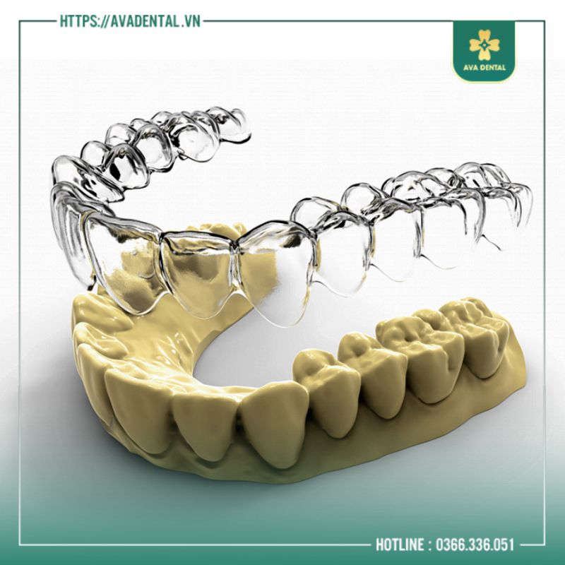 niềng răng invisalign giá