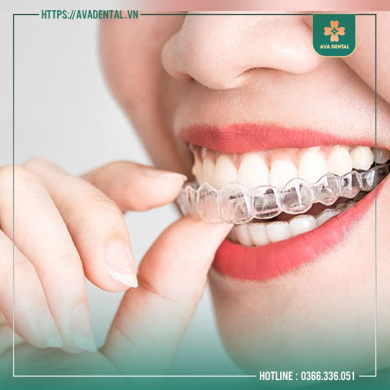 NIỀNG RĂNG TRONG SUỐT CÓ HIỆU QUẢ KHÔNG? 11 niềng răng trong suốt
