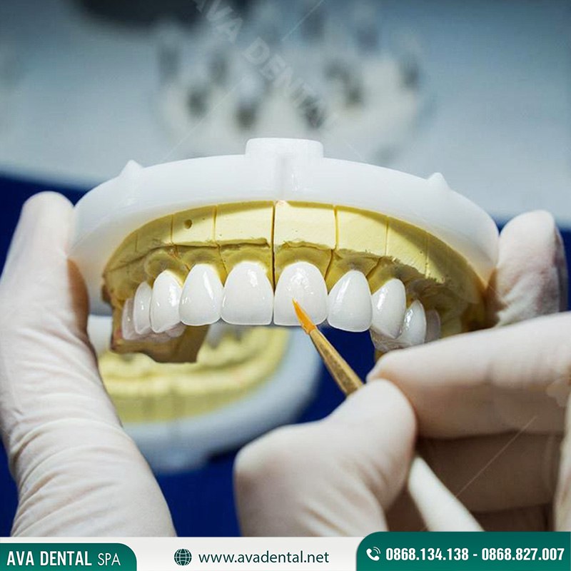 các loại răng sứ