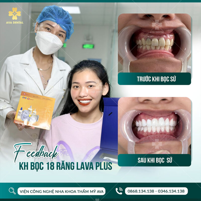 quy trình bọc răng sứ