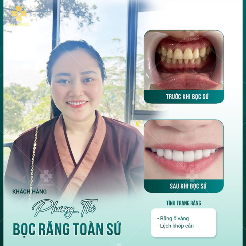 Chi Phí Bọc Sứ Răng Cửa Bao Nhiêu Tiền? 12 bọc sứ răng cửa bao nhiêu tiền