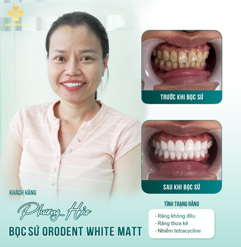 răng sứ orodent