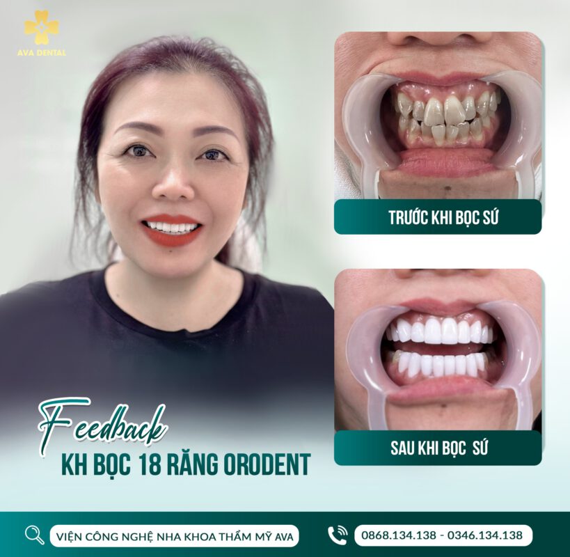 răng sứ orodent