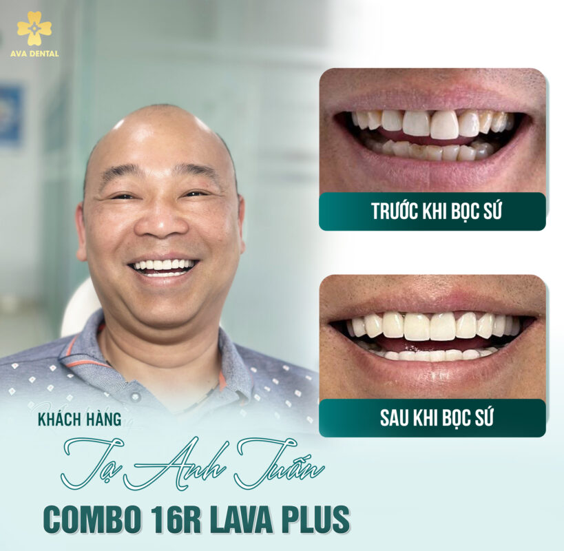 Bọc răng sứ có tốt không