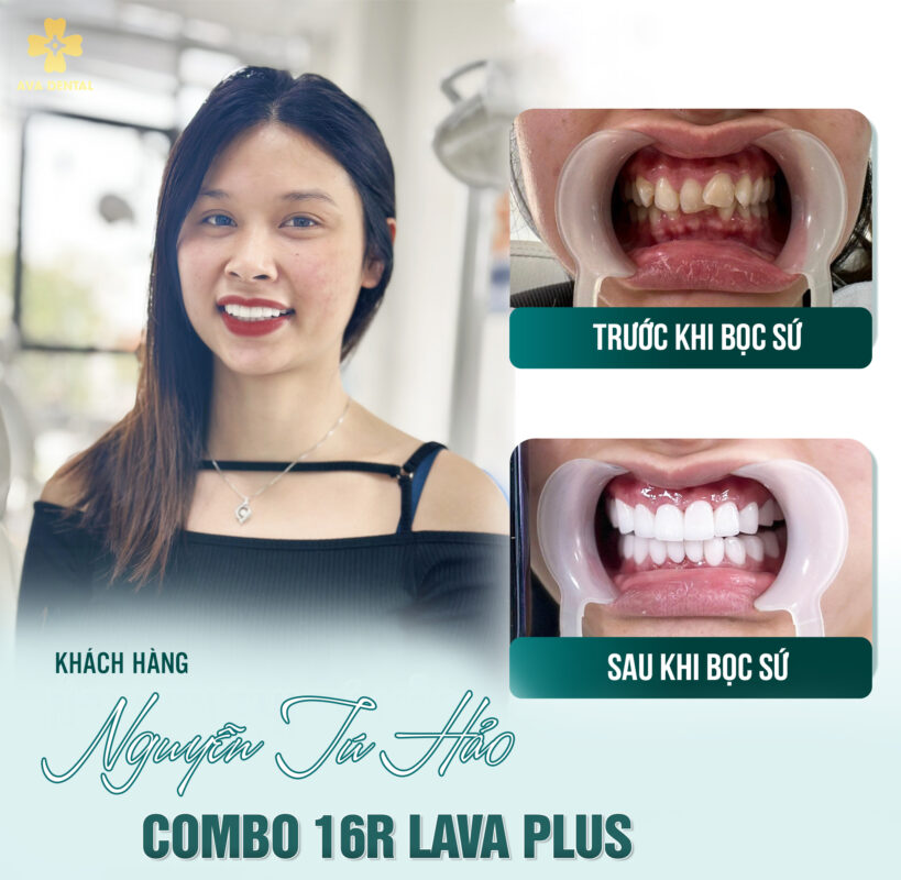 Bọc răng sứ có tốt không