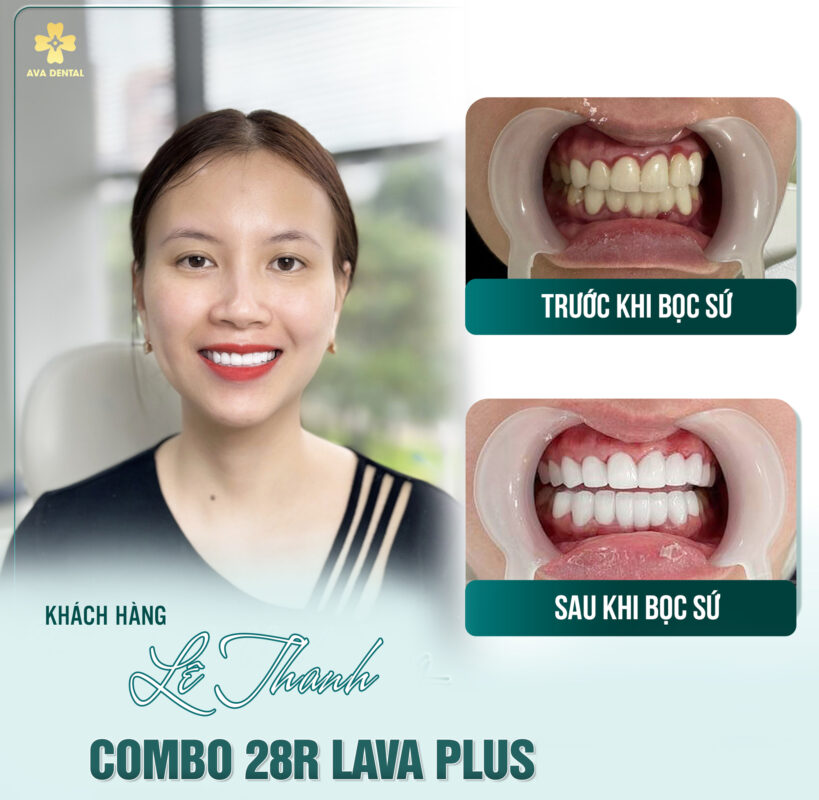 Tham Khảo Quy Trình Bọc Răng Sứ Tại Nha Khoa Avora Dental 13 quy trình bọc răng sứ