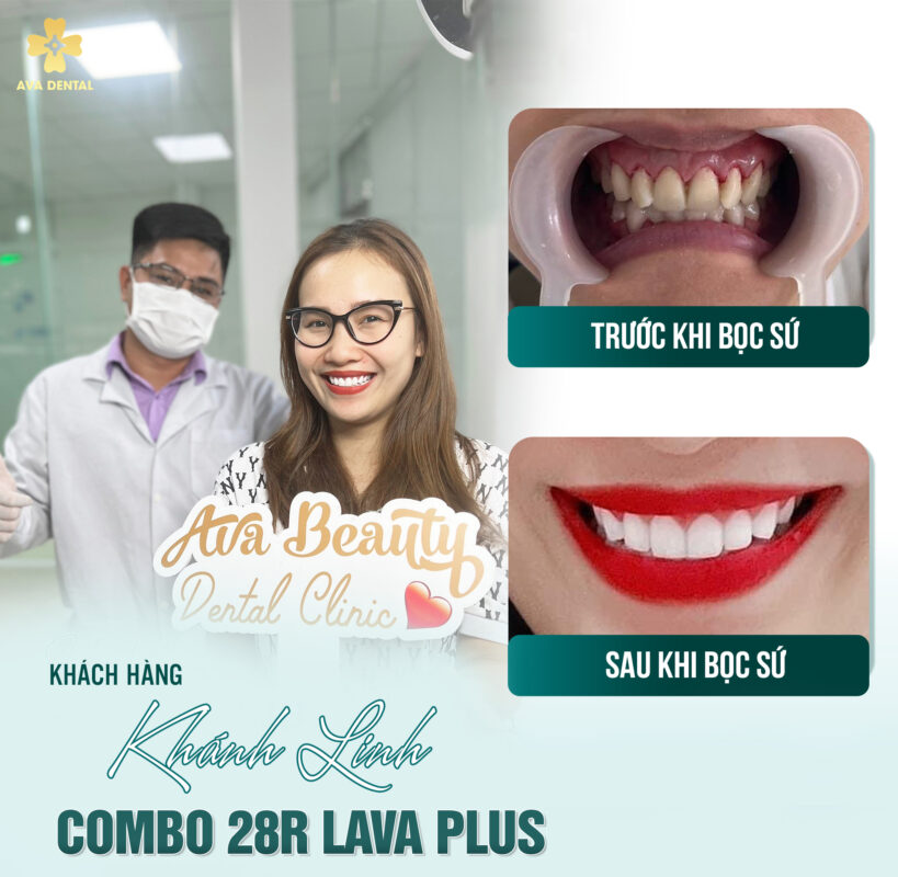 quy trình bọc răng sứ