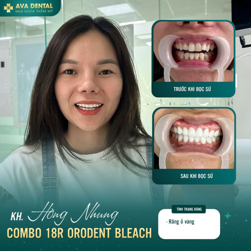 răng sứ orodent