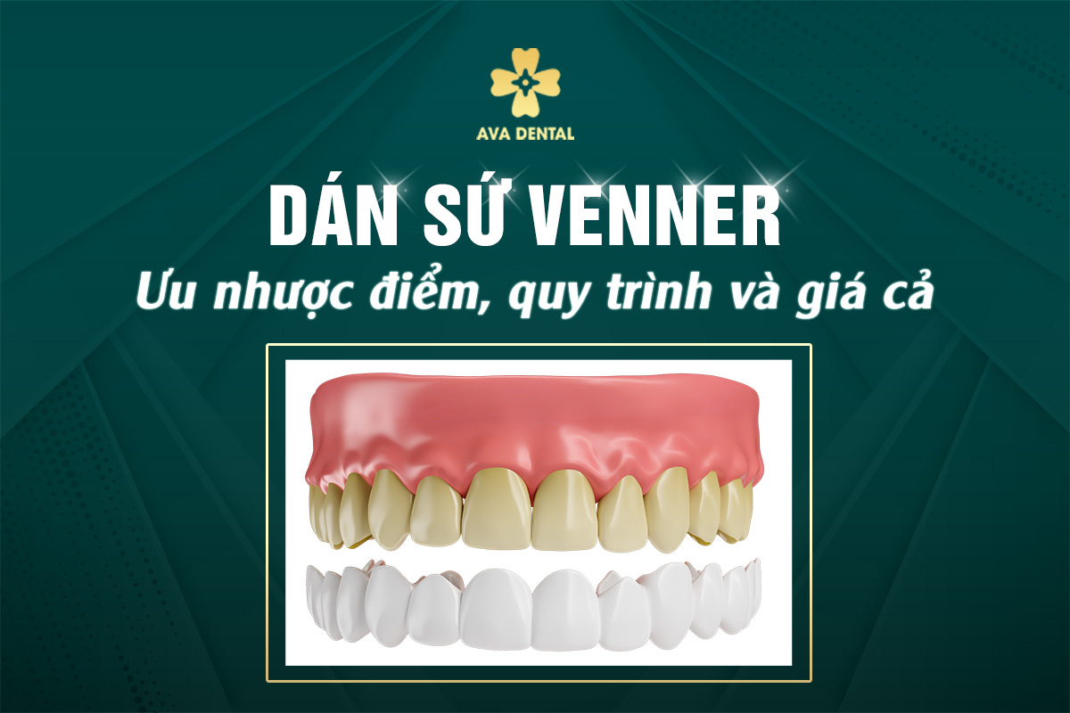 dán sứ veneer