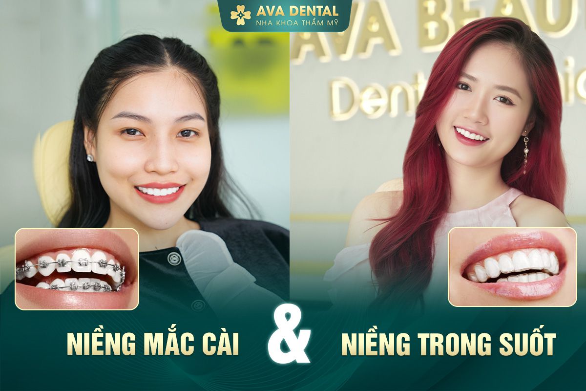 giá niềng răng