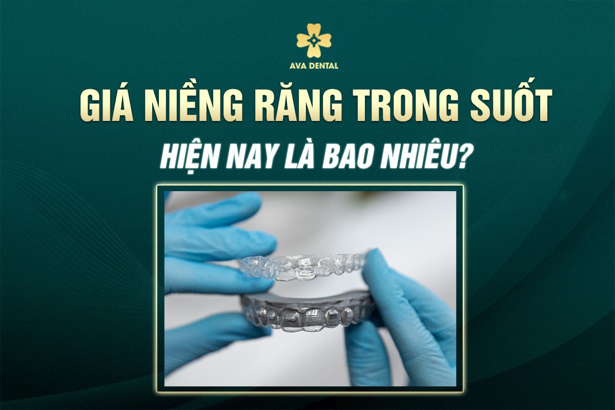 giá niềng răng