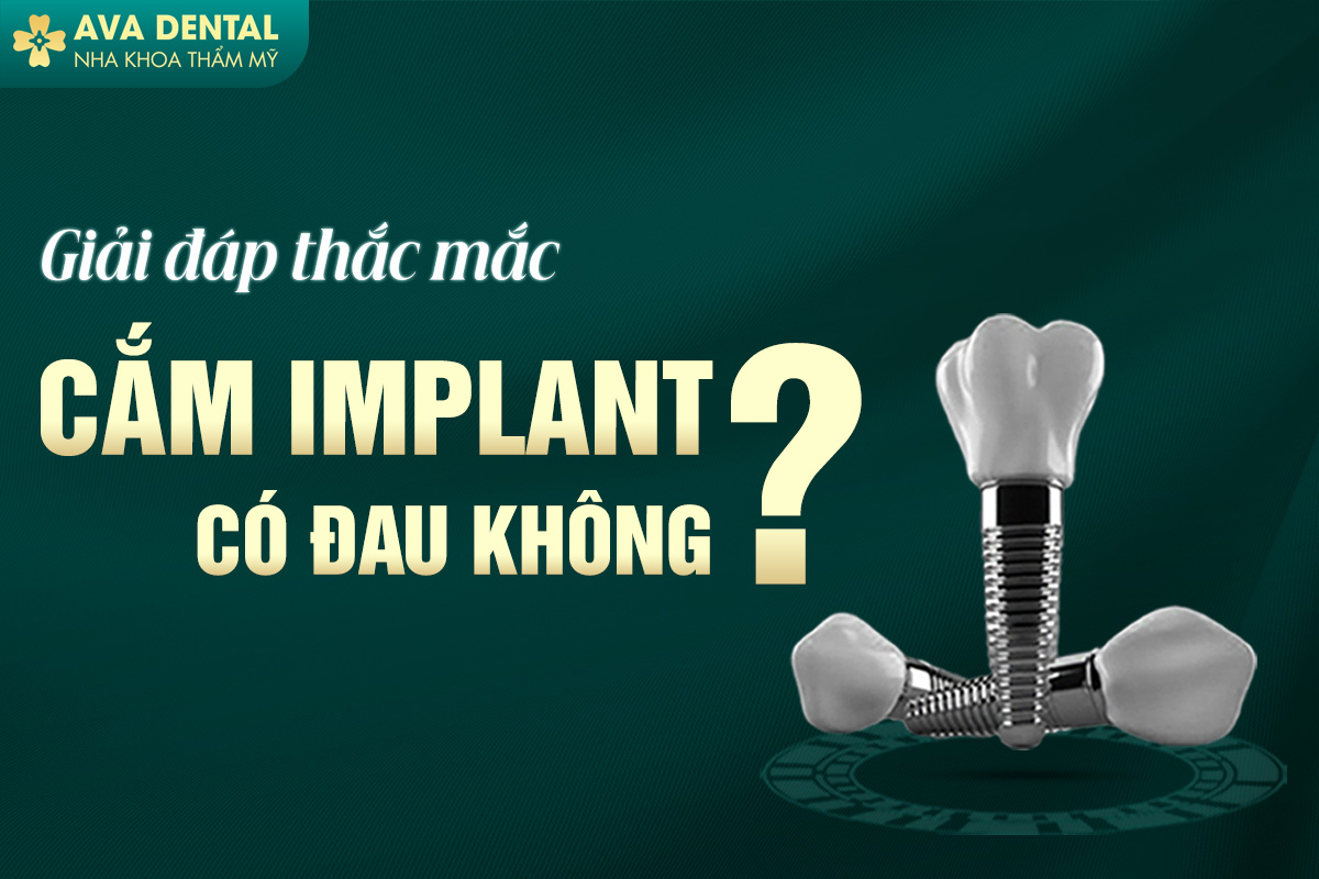 Trồng Răng Implant Là Gì? Có Đau Không? 7 trồng răng implant