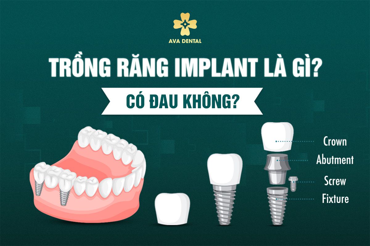 Làm Răng Implant Có Tốt Không? Giá Bao Nhiêu 6 làm răng implant