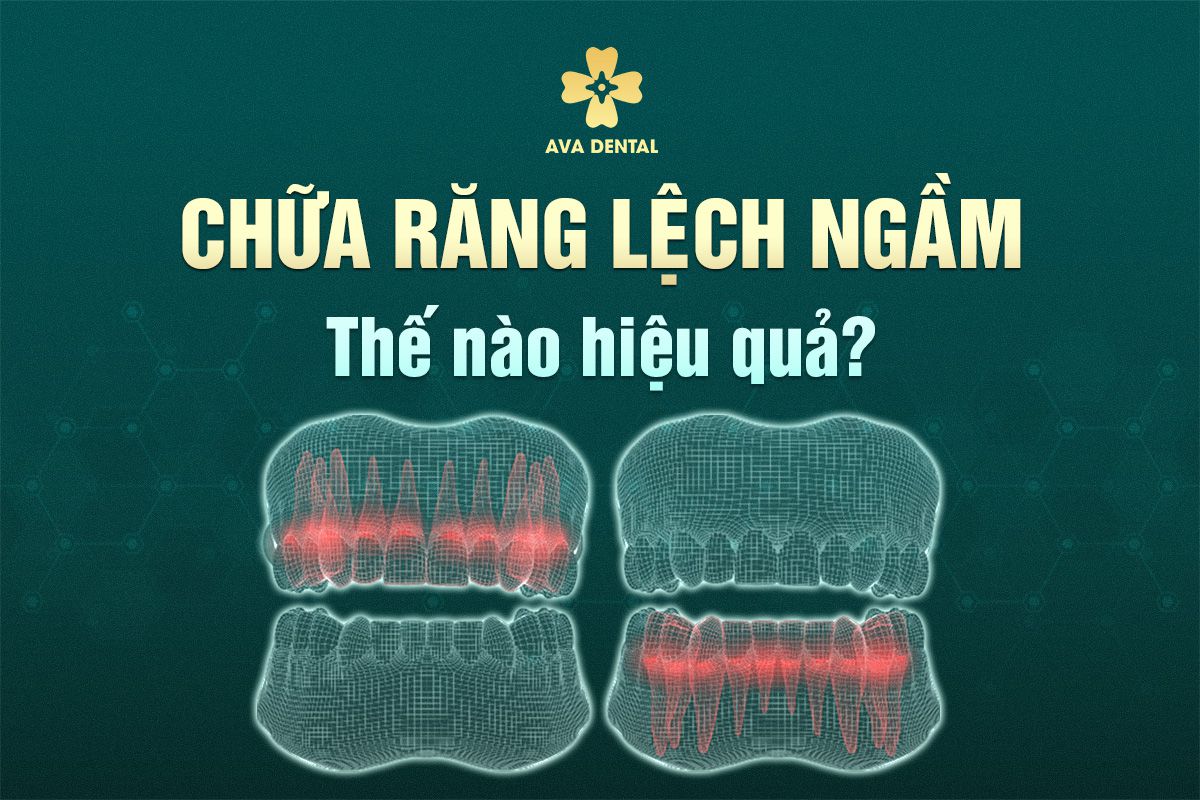 chữa răng lệch răng ngầm
