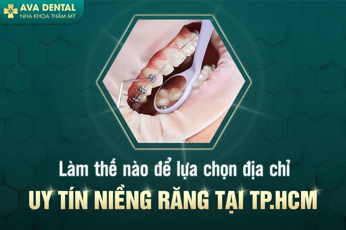  niềng răng tại tphcm