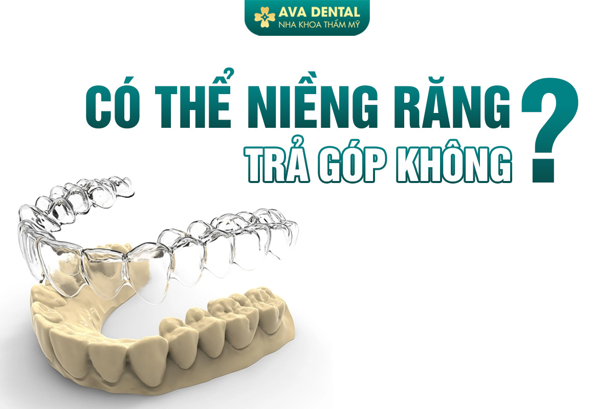 niềng răng trả góp
