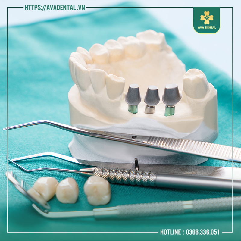 mất răng lâu năm có trồng implant được không