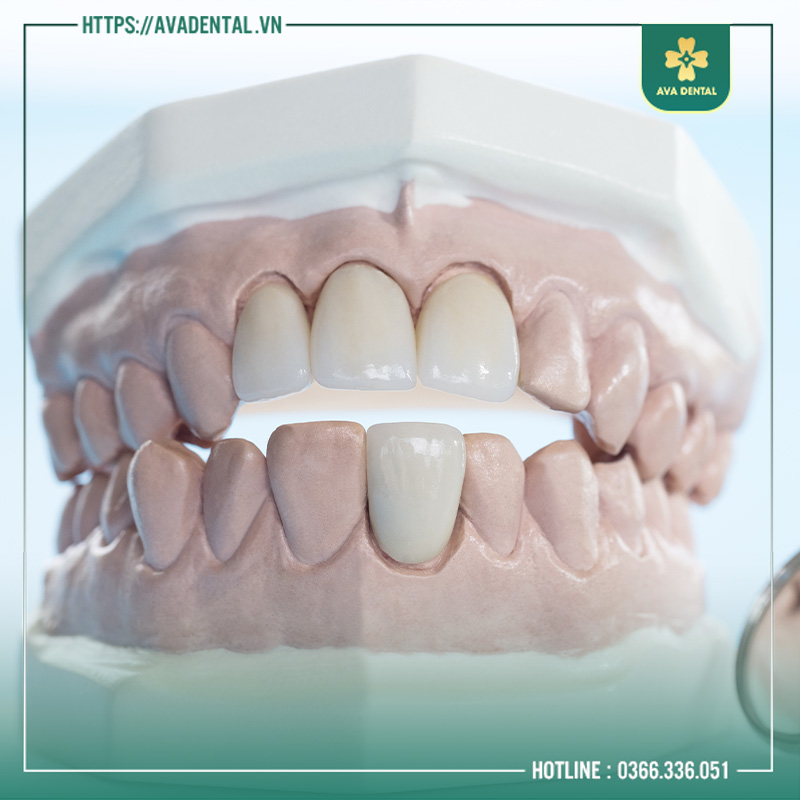Răng sứ Orodent giá bao nhiêu? Làm răng ở đâu uy tín 6 SEO VUONG 4
