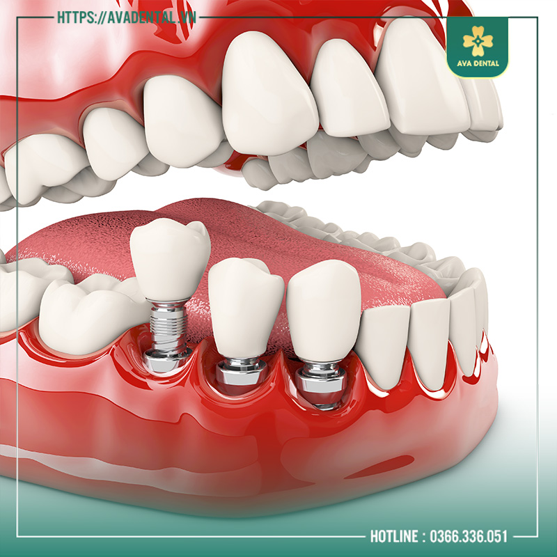 mất răng lâu năm có trồng implant được không