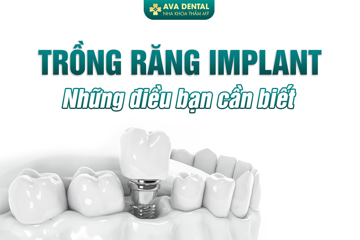 TRỒNG RĂNG IMPLANT- NHỮNG ĐIỀU BẠN NÊN BIẾT 8 trồng răng implant