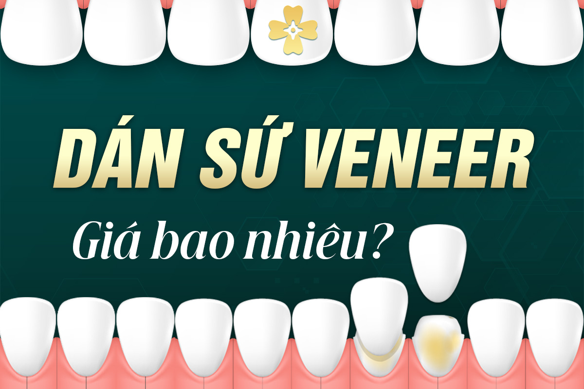 dán sứ veneer giá