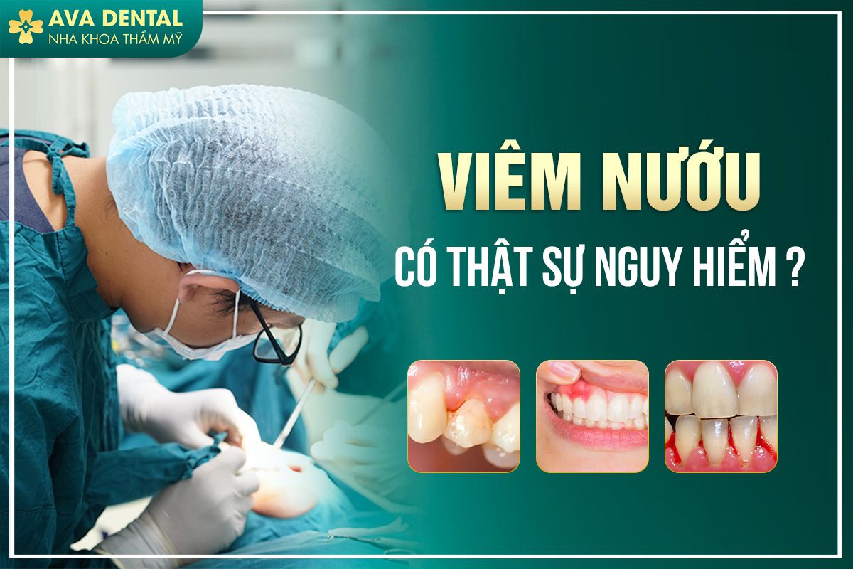VIEM NUOU