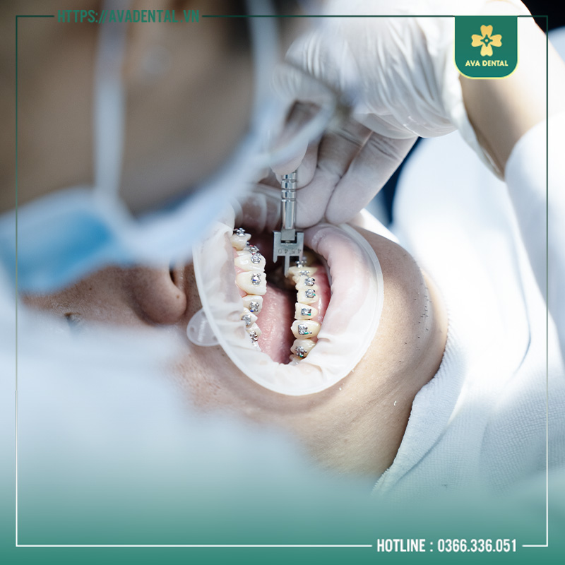 niềng răng uy tín ở tphcm
