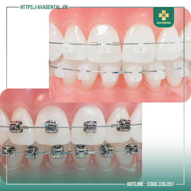 Niềng Răng Thẩm Mỹ Là Gì? Những Ai Nên Niềng Răng? 11 mac cai su kim loai